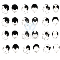 【J9官网 J9基因检测】过早<font color='red'>脱发</font>、掉发太多怎么办？你的方法可能是错的！